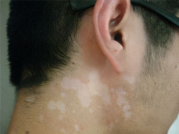 不良习惯引起白癜风,白癜风通过改善生活习惯能改善吗