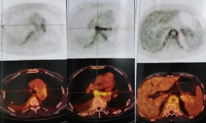 咳嗽咳痰胸腔积液10月余治疗无效，艰难追踪得出哪些教训？（上）