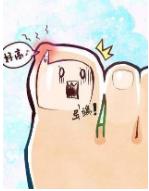 生活小妙招：嵌甲，就这样处理，绝对安全无毒！一招见笑