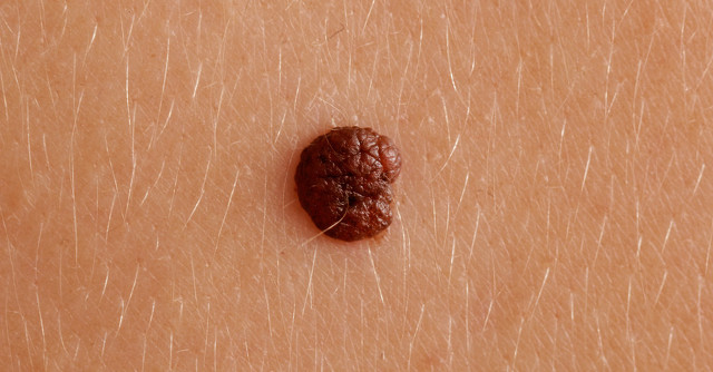 头皮长了个小疙瘩不痛不痒,头皮长了个小肉瘤像疣一样是什么