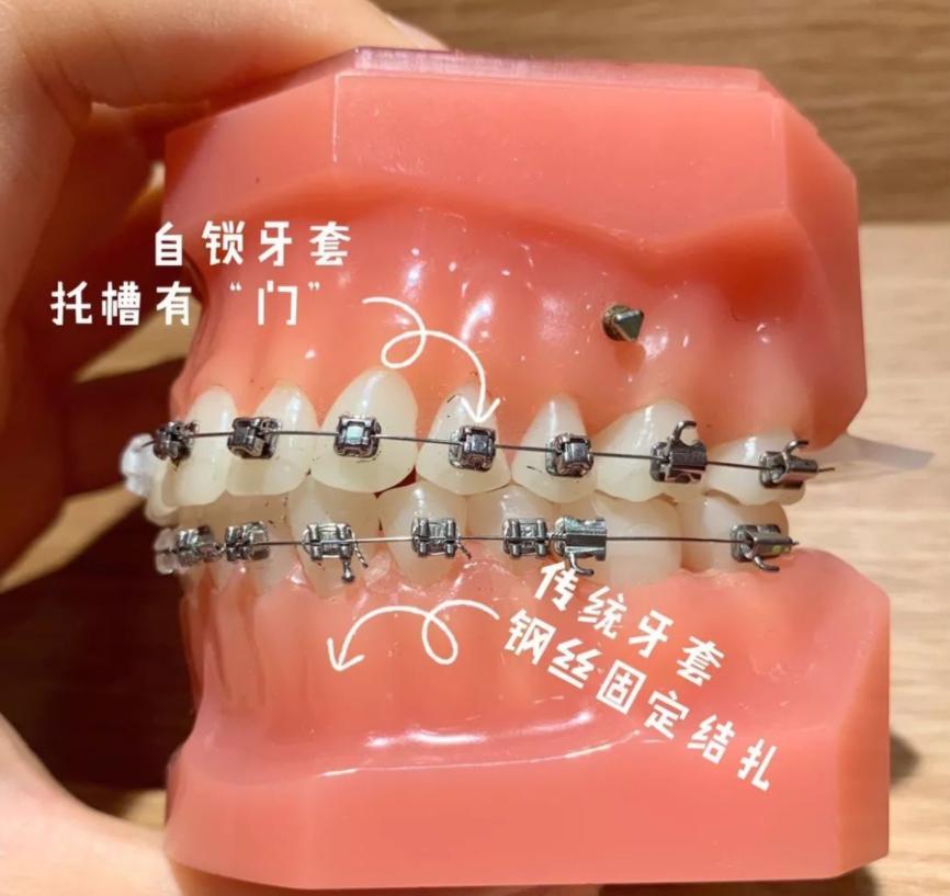 什么情况需要牙齿矫正一般多少钱,为什么去医院矫正牙齿每次都收费