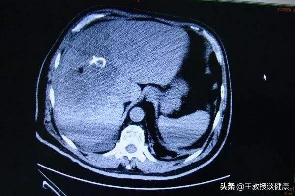 肛周脓肿是不是糖尿病引起的,脓肿为什么会有硬结