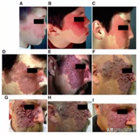 面容杀手,常见胎记的类型
