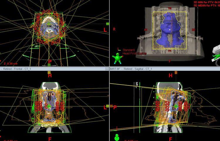 一期癌症放射治疗治愈率,放射治疗是姑息还是根治