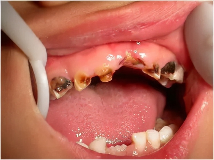 孩子坏牙是缺什么还是吃糖导致的,宝宝牙齿全烂了怎么办