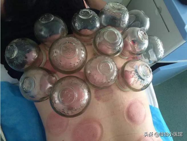 中医火罐疗法有哪些注意事项,中医火罐穴位图