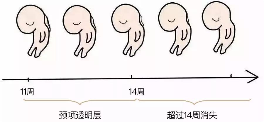 产检做nt唐筛有什么区别吗,产检做NT要提前预约吗