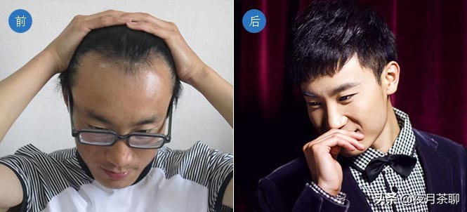 发际线太高怎么办一招解决,我发际线秃了怎么办