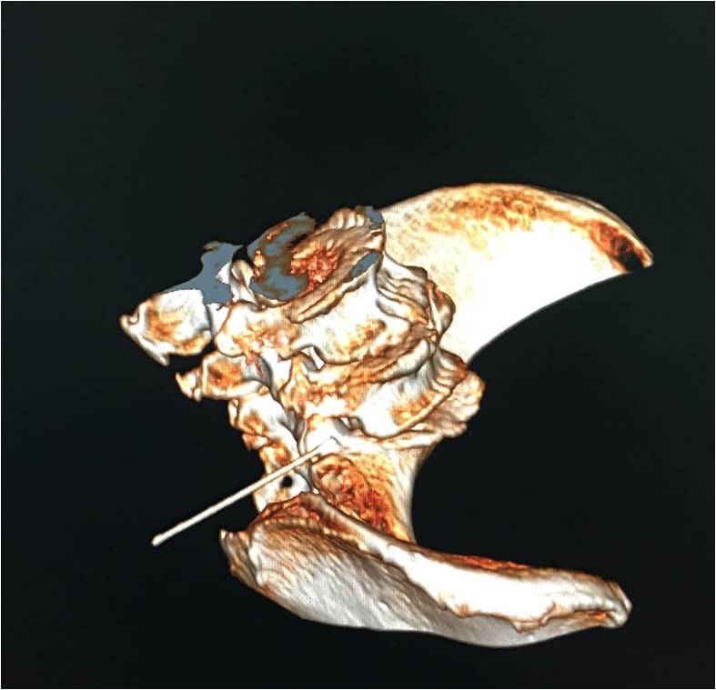 极外侧型腰椎间盘突出微创治疗,松解筋膜治疗腰椎间盘突出