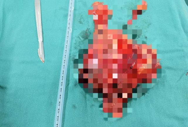 眼皮耷拉的厉害是怎么回事,眼睛眼皮往下耷拉肌无力怎么治