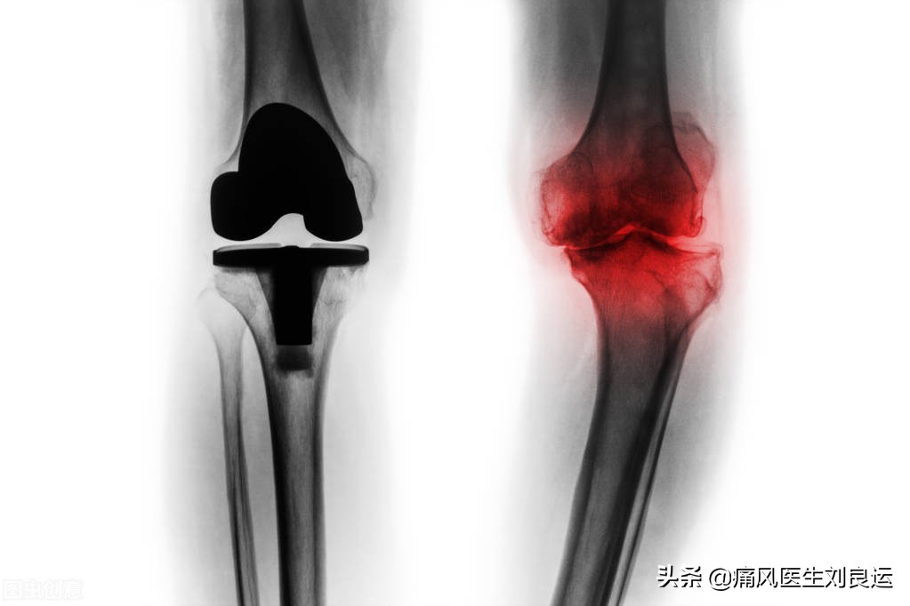 痛风会在脚趾和膝关节同时发作吗,痛风发作从脚趾头到脚踝又到膝盖