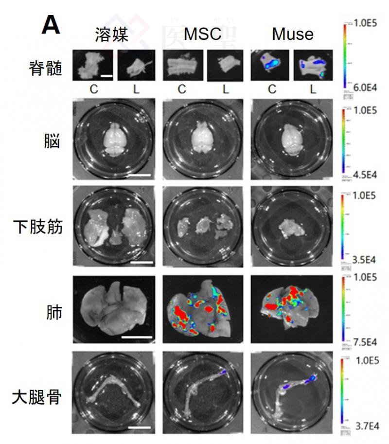 日本渐冻人症特效药 (渐冻人症细胞治疗)