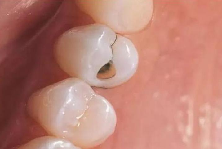 电动牙刷2023推荐平价,电动牙刷推荐2023年