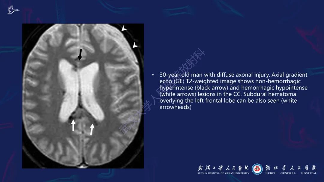胼胝体肿瘤影像鉴别,胼胝体病变影像诊断
