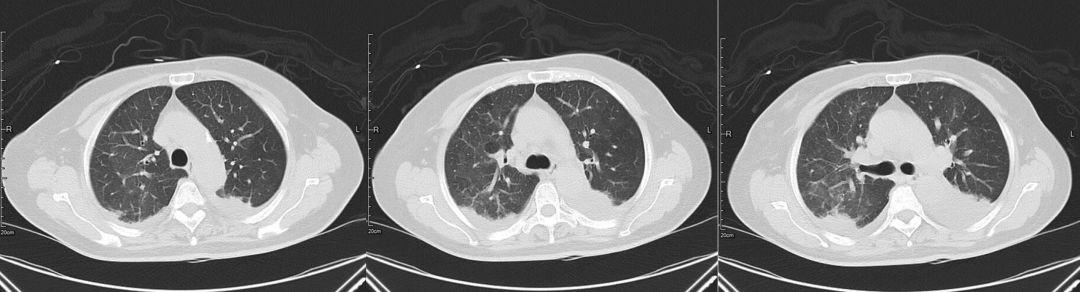 这例患者差点误诊为CAP，类似病变应如何逃离误诊「高发区」？