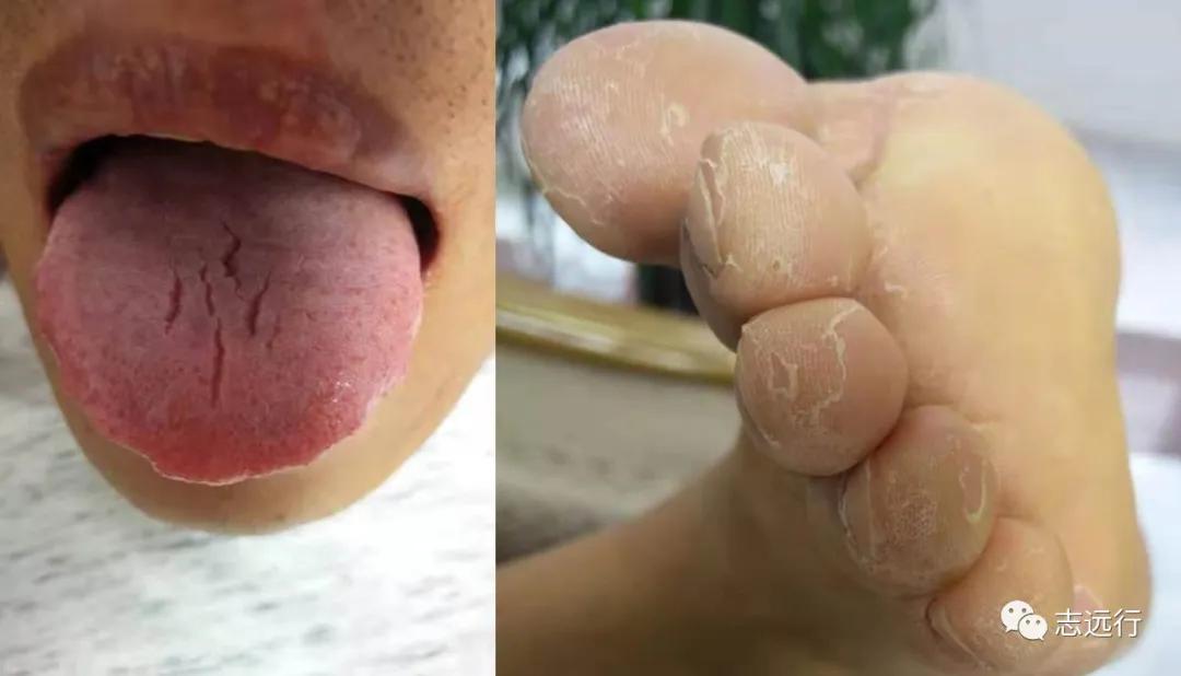 张景明治疗手足癣的中药方,手足癣单方大全