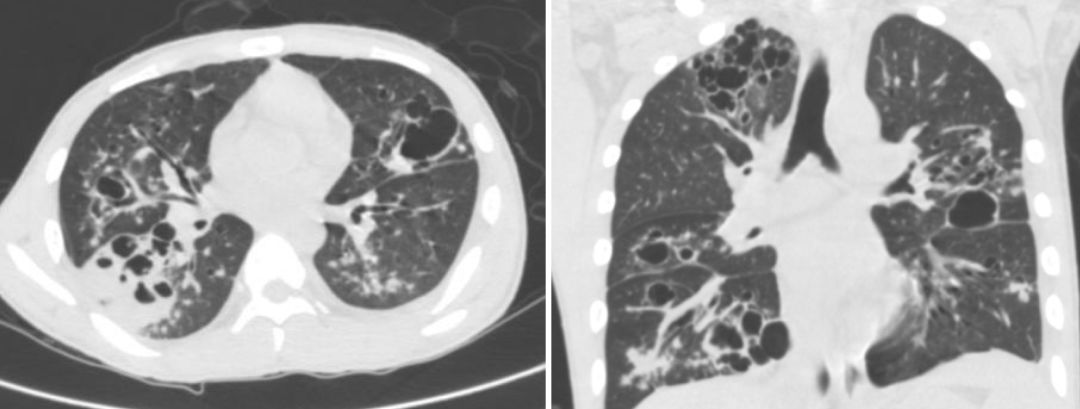 金葡菌感染肺炎能自愈吗,流感病毒诊断的金标准