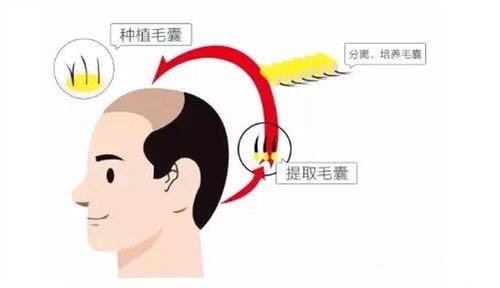 植发脱落期看不到毛孔是怎么回事,植发后脱落期和狂脱期有什么区别