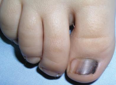 宝宝指甲出现白点,孩子指甲上有白色斑点倪海厦