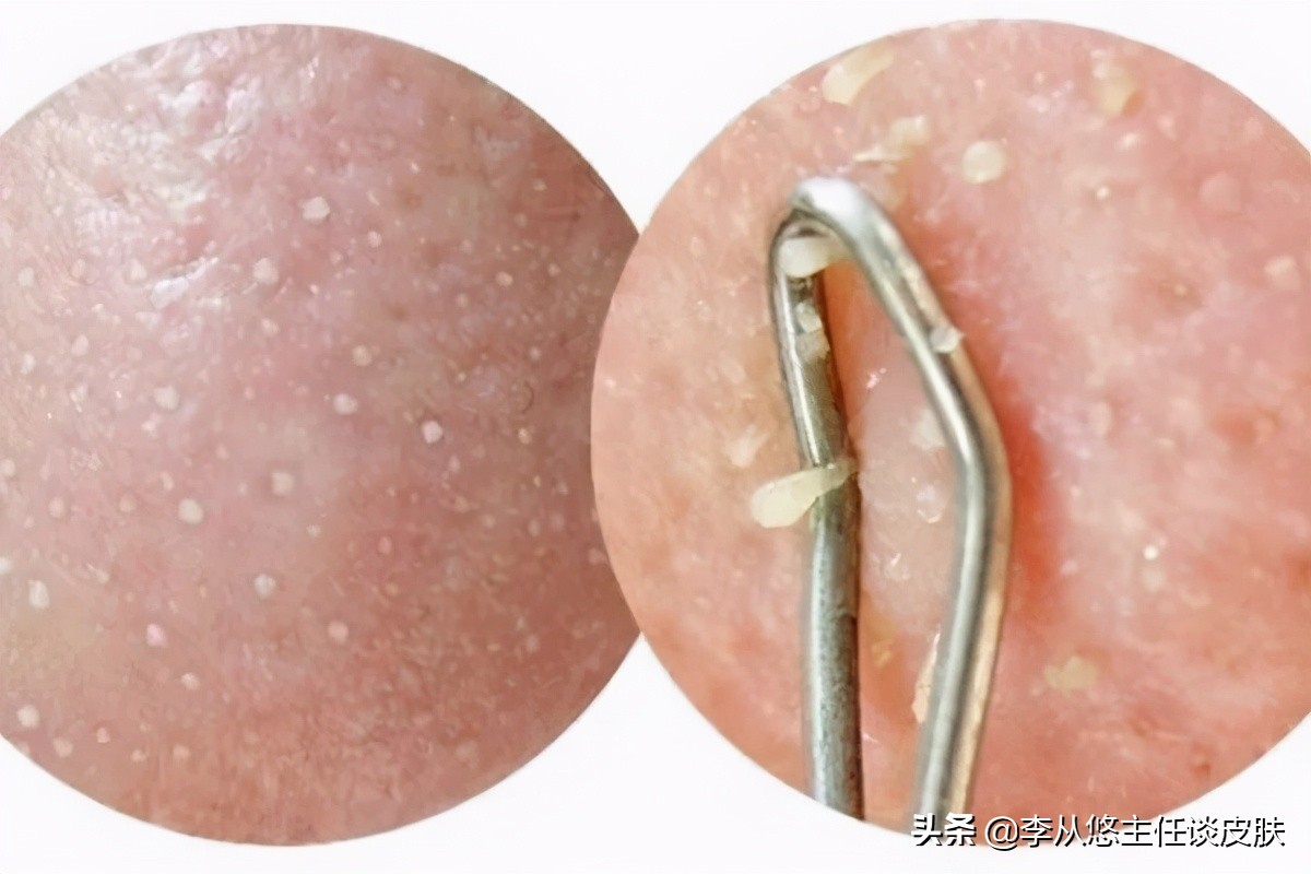 鼻子上长痘痘是最尴尬的了,红肿会显得人很像小丑