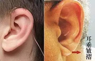 耳朵的耳垂上有深痕是什么原因,耳朵耳垂有一道痕怎么调理