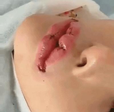 医美最火的项目,哪些皮肤类医美项目不建议做