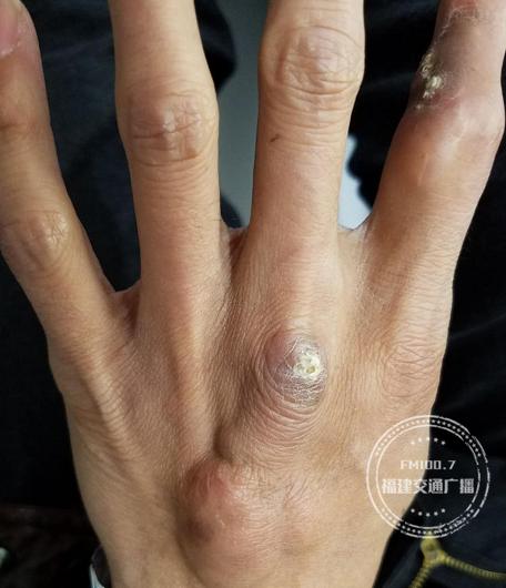 男子身上长出了石头,全身长石头后来怎么样了