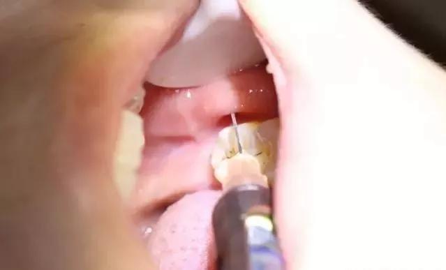 拔牙打麻药会影响恒牙的发生吗,拔牙时打麻药会不会引起口腔溃疡