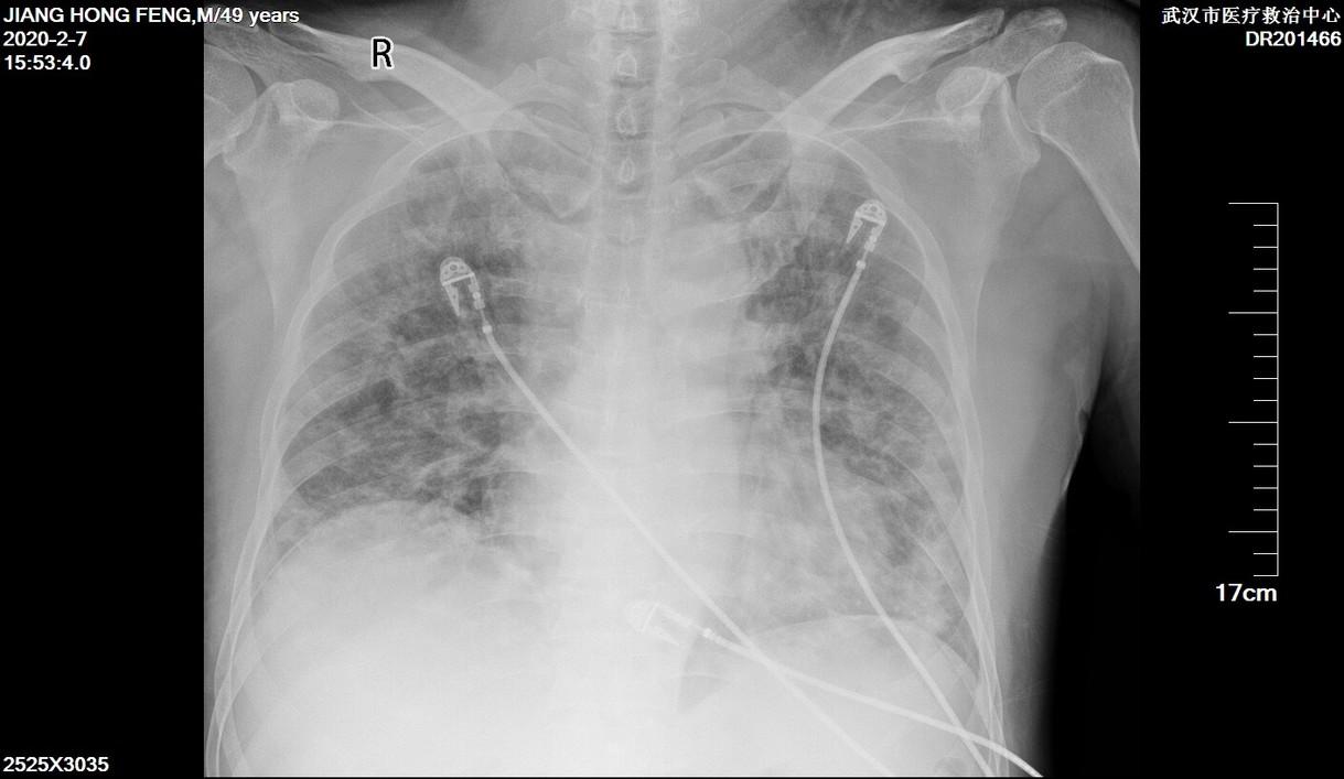 我的疫情日记100篇,我的新冠康复日记200字