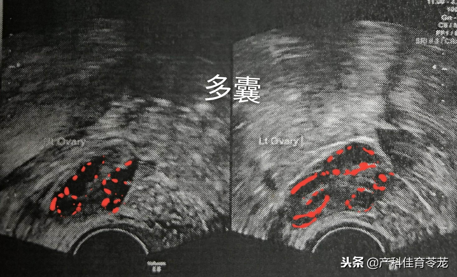 卵巢囊肿是黄体囊肿吗,盆腔囊肿是卵巢囊肿吗