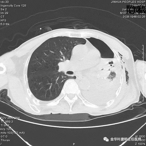 肺手术后乳糜胸是医疗事故吗,肺部切除后乳糜胸治好了