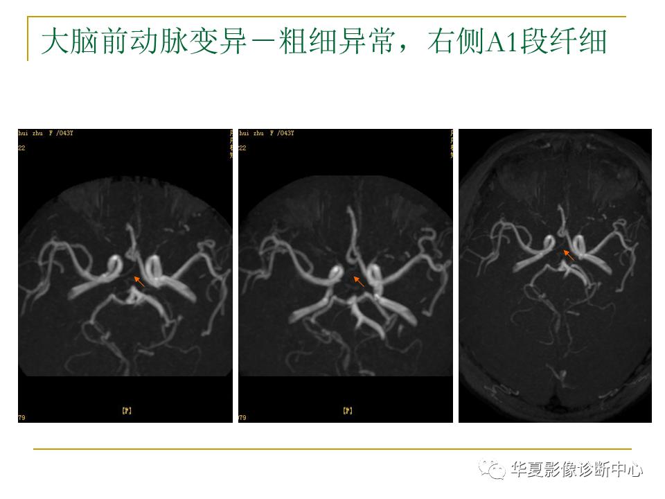 中国人脑立体定向mri应用解剖图谱,脑mri示意图