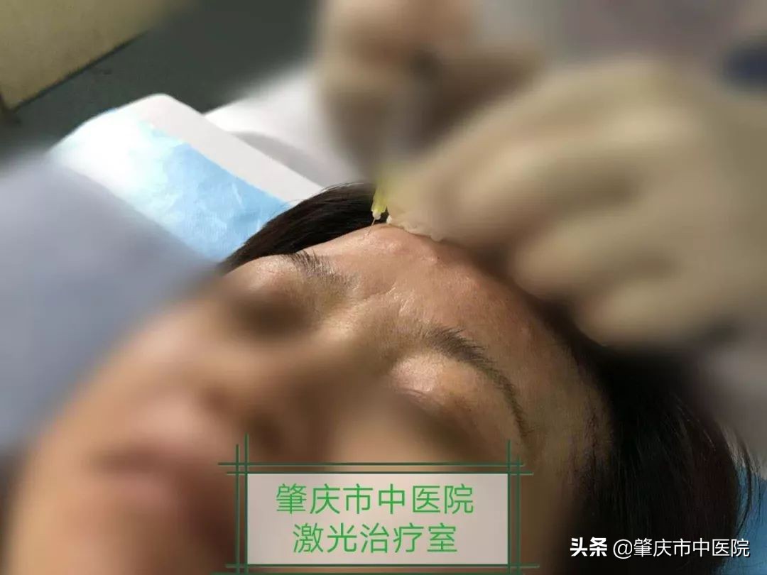 除了肉毒素还有什么能去皱,肉毒素去皱适合年龄