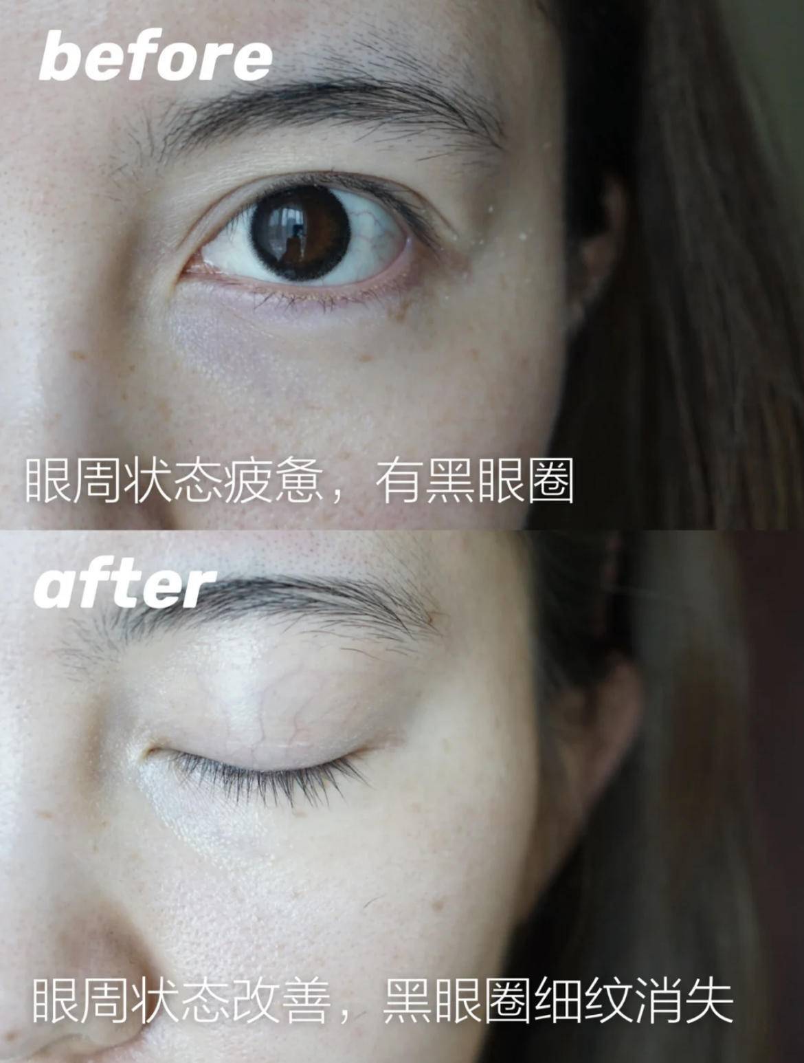 眼周水肿的原因分析,如何改善眼皮浮肿