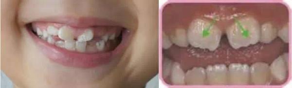 六岁孩子要换牙需要注意什么,七岁小朋友换牙需要注意什么