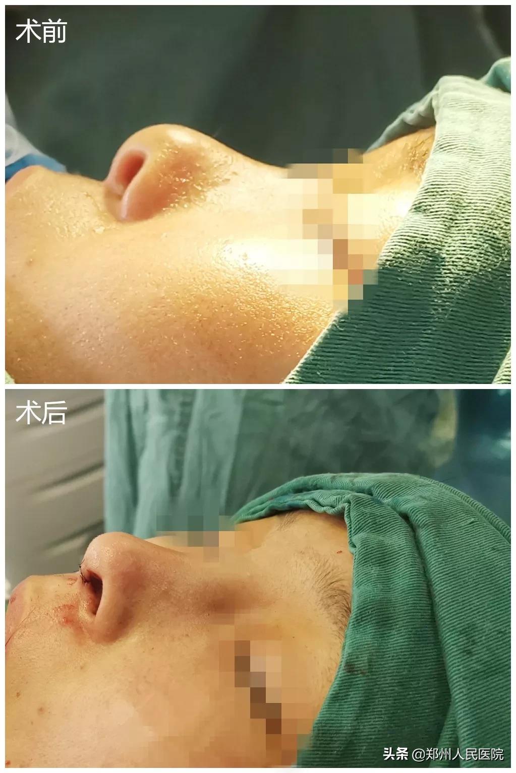 鼻子变好看的方法速成,让鼻子变好看图集