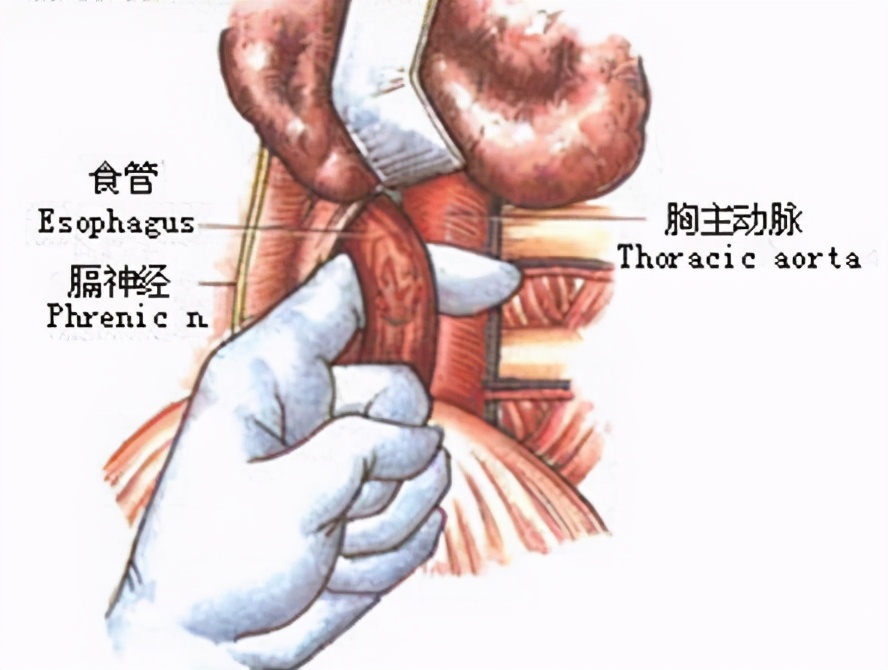 食管贲门失弛缓症的治疗方法,贲门弛缓症引起的食管扩张能治吗