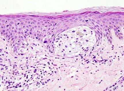 恶性黑色素瘤的靶向治疗进展,癌症基因治疗最新突破