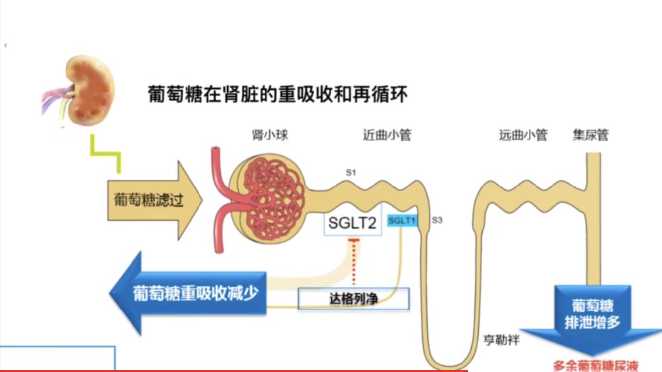 尿糖阳性达格列净停药,服用达格列净后尿糖一般几个加号