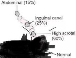 男宝宝的蛋蛋怎么不见了