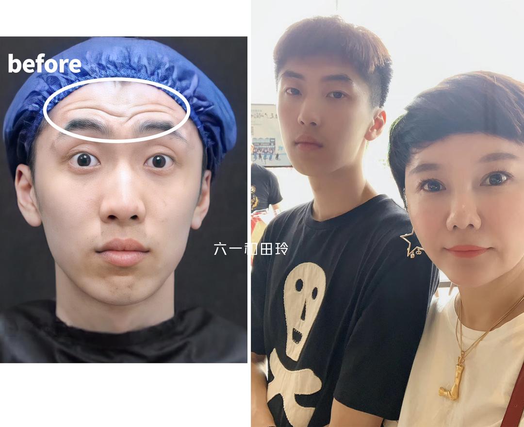 额头细纹皱纹怎么区别,额头上的细纹怎么解决