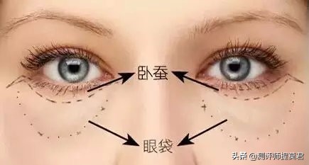 眼袋和泪沟相关知识,眼袋和卧蚕的区分方法