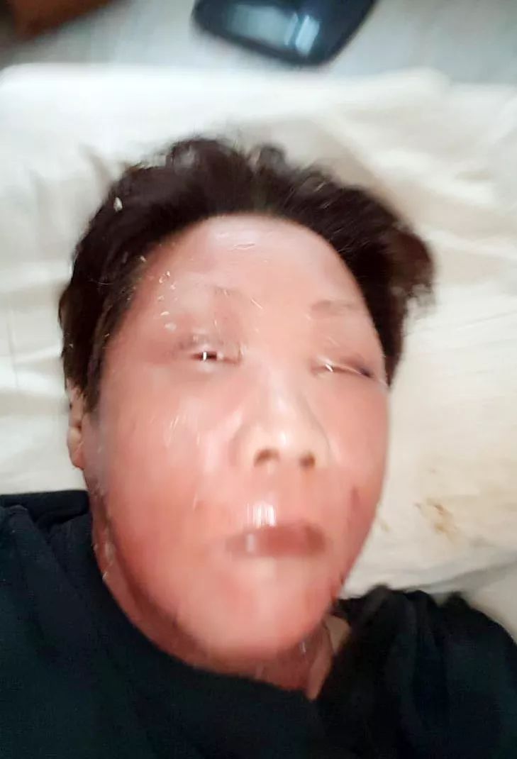 皮炎吃什么中成药能彻底根治,中医治疗皮炎一个疗程是多久