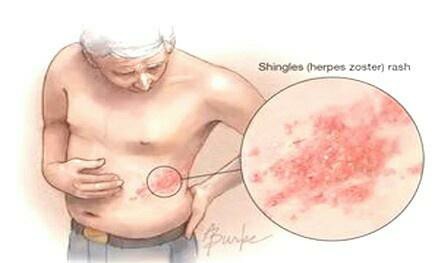 带状疱疹看中医还是看西医好,带状疱疹看中医西医