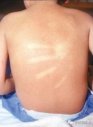 猩红热是皮肤病吗,猩红热样皮炎会传染吗