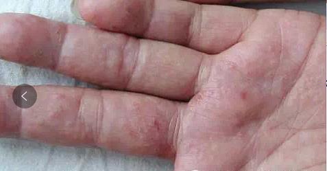 汗疱疹到夏天手脚起小水泡很痒,夏季汗疱疹是什么原因