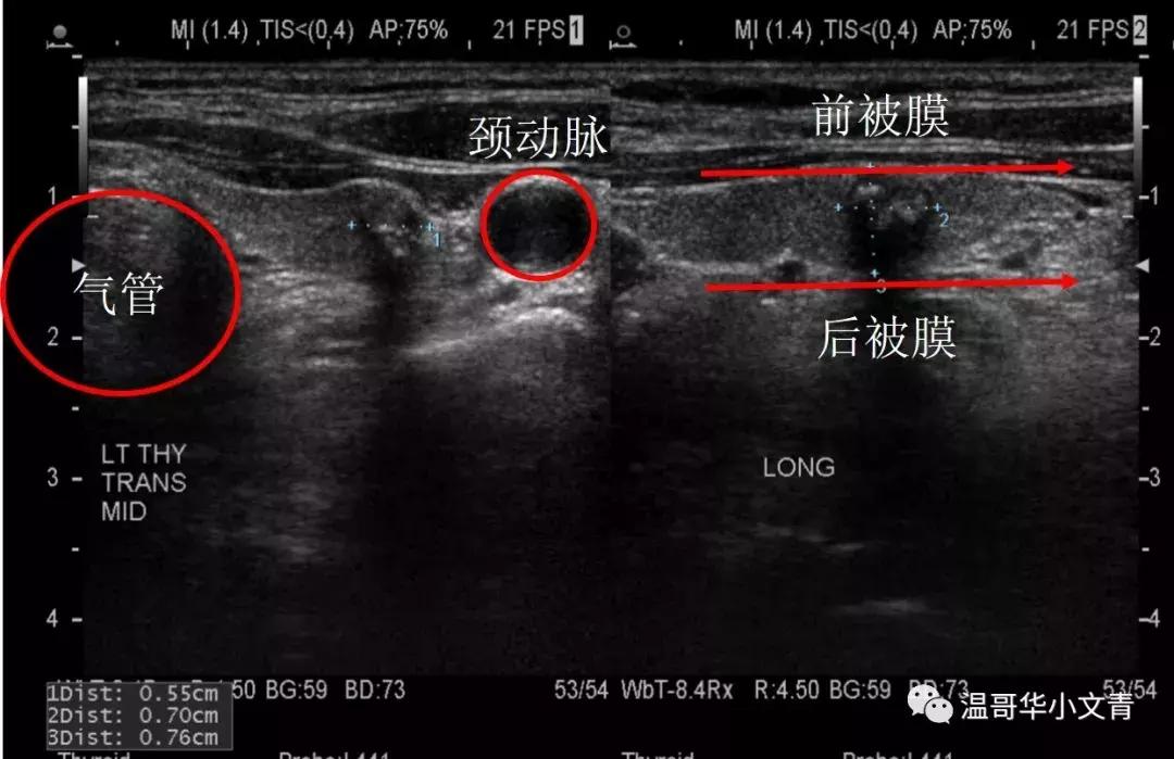 甲状腺癌治疗最好的医院排名,中药治疗甲状腺癌的有效方法