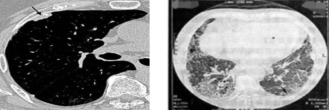 56岁男性发现双肺,56岁男性发现双肺数百个结节