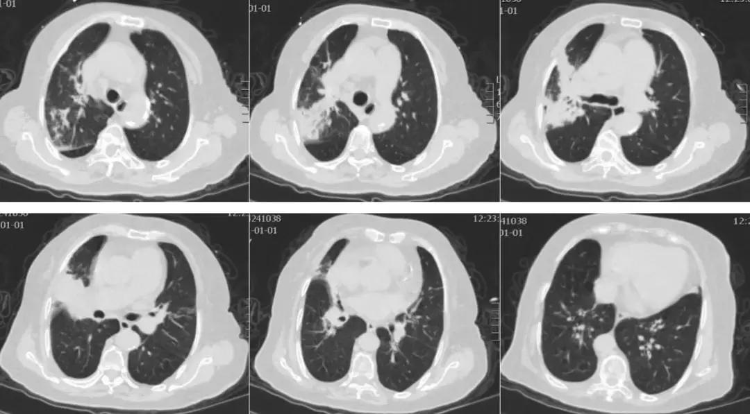 病人无法脱离插管呼吸机,病人无法脱离呼吸机如何转院