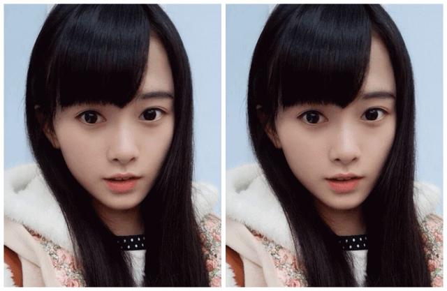 颧弓高脸型怎么改善,有泪沟可以通过调整脸型改善嘛